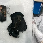Portable charger explodes in bed, leaves woman with chemical burns 3 Portable charger explodes in bed, leaves woman with chemical burns